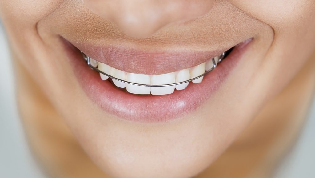 Beautiful Smile With Retainer