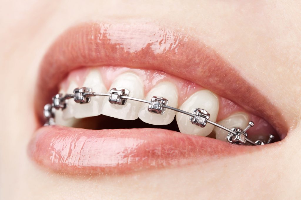 who offers invisalign braces philips?