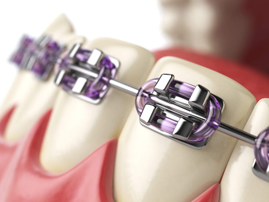 Where should I get dental braces Ladysmith?