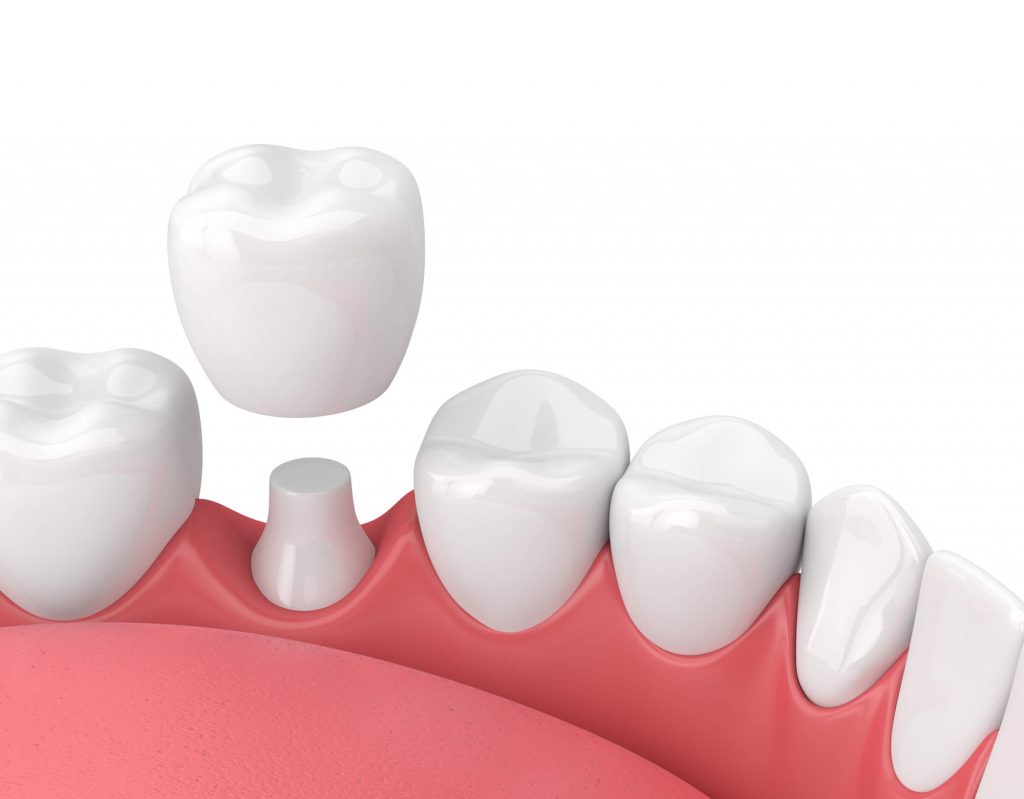What are Crowns Phillips?