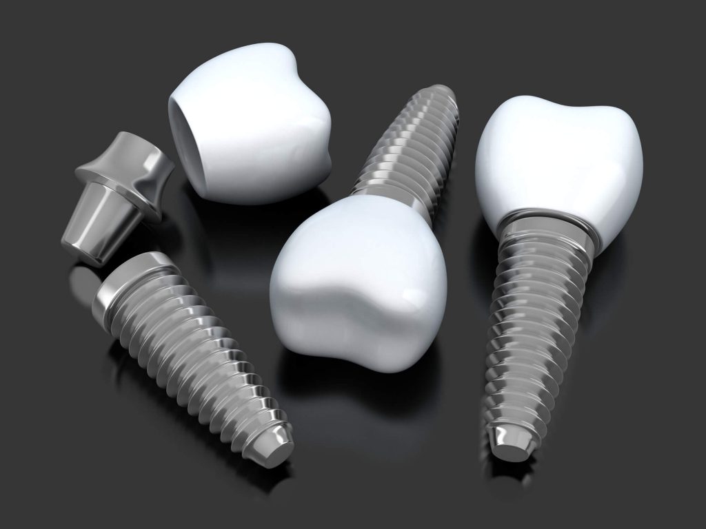 What are Dental Implants Medford?