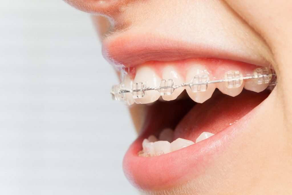 Clear Braces Phillips