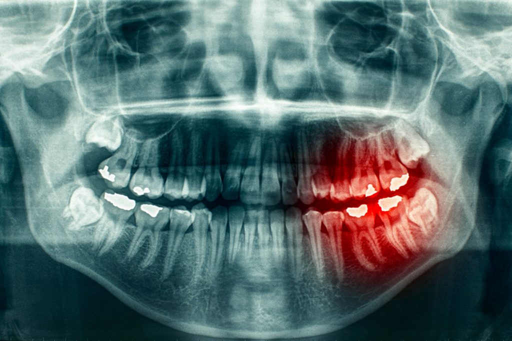 Panoramic X-rays Phillips