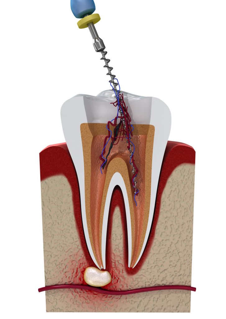 tooth needing a root canal dentist in Park Falls