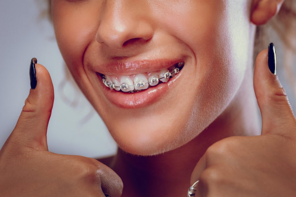 a woman wearing Dental Braces in Ladysmith gives her two thumbs up
