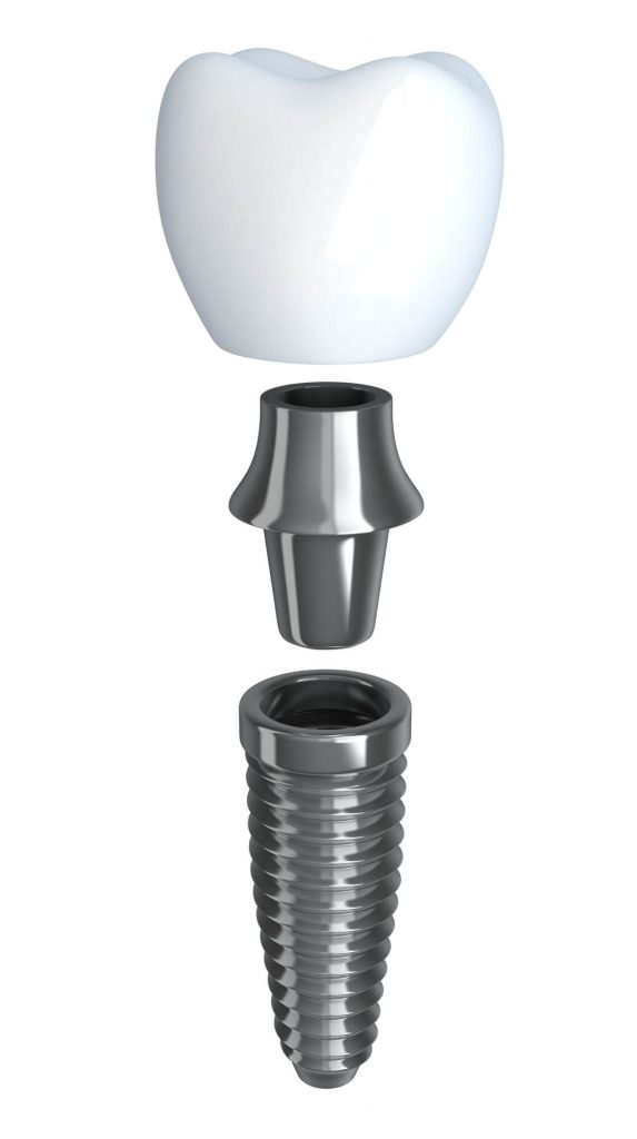 deconstructed dental implants in Medford