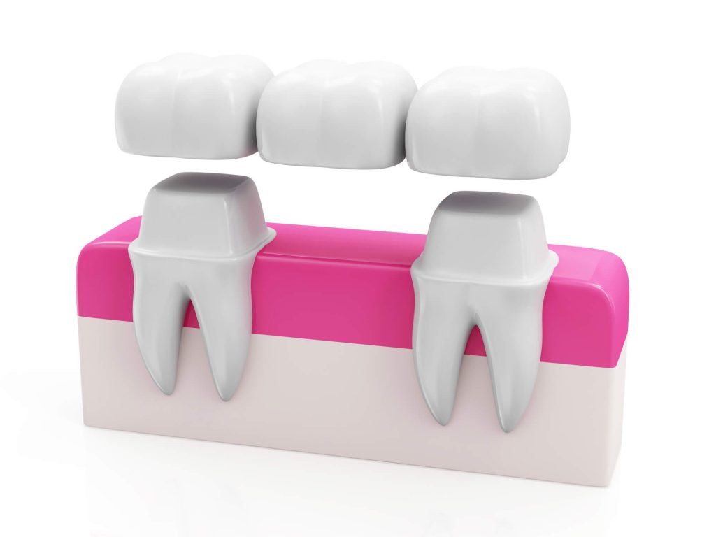 three dental crowns in Phillips