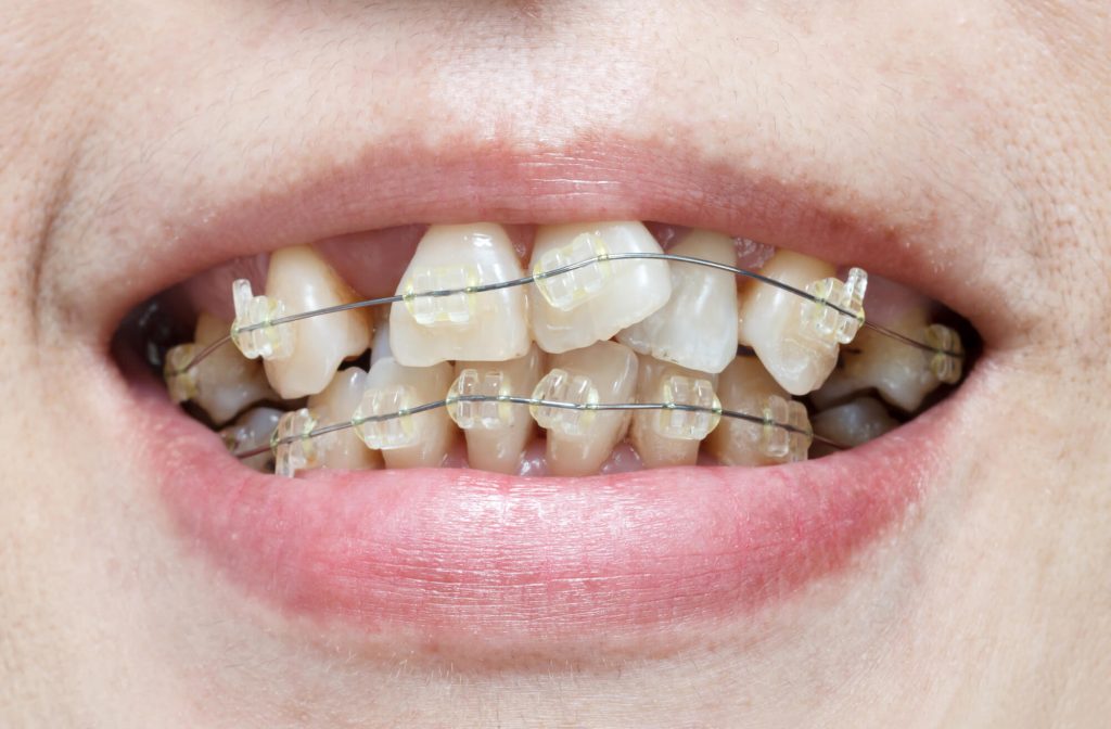 Close-up mouth of crooked teeth with braces and medford orthodontist