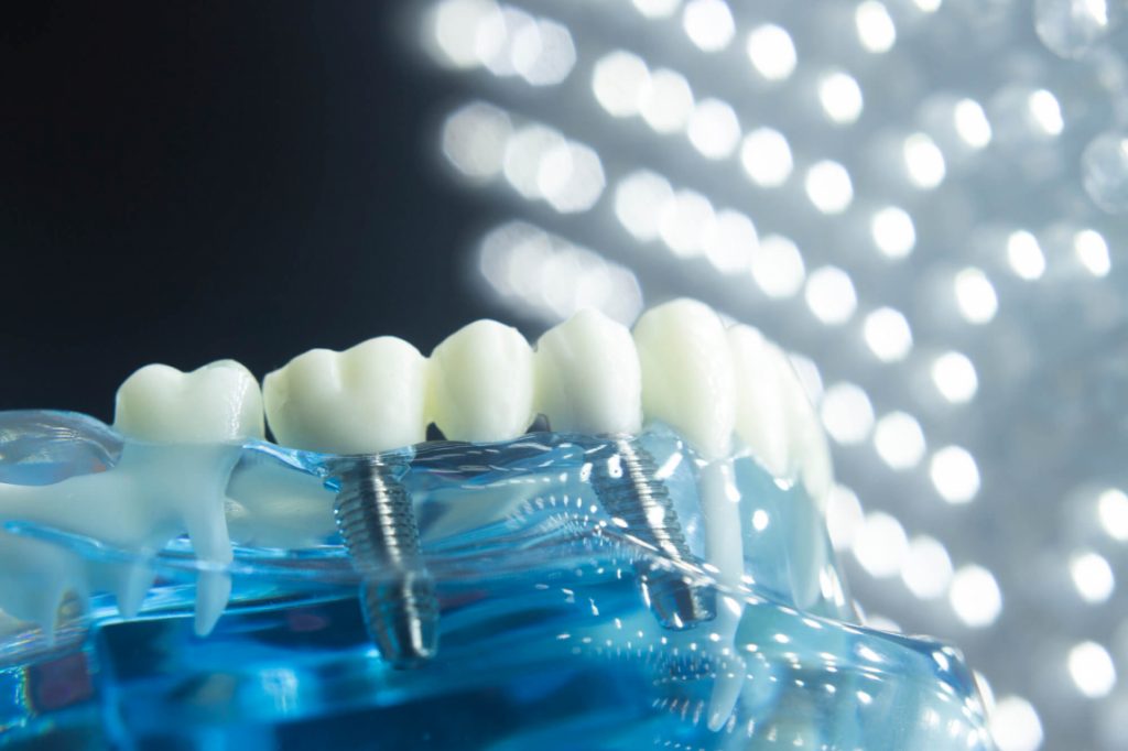 model of dental implants in Ladysmith