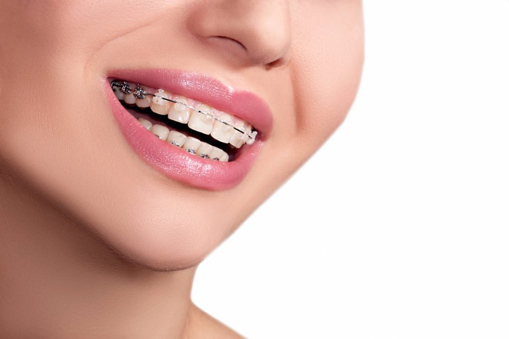 woman shows clean dental braces in Ladysmith