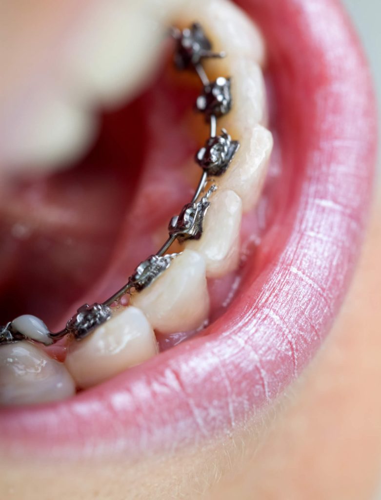 panoramic x-rays in Phillips for dental braces