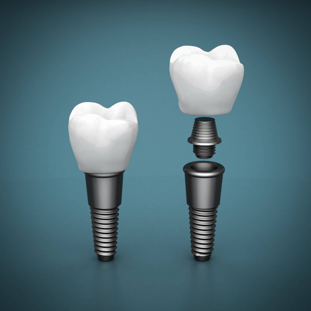 3D image of dental implants in ladysmith