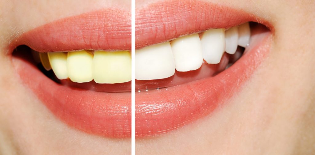 comparison of teeth whitening in Park Falls