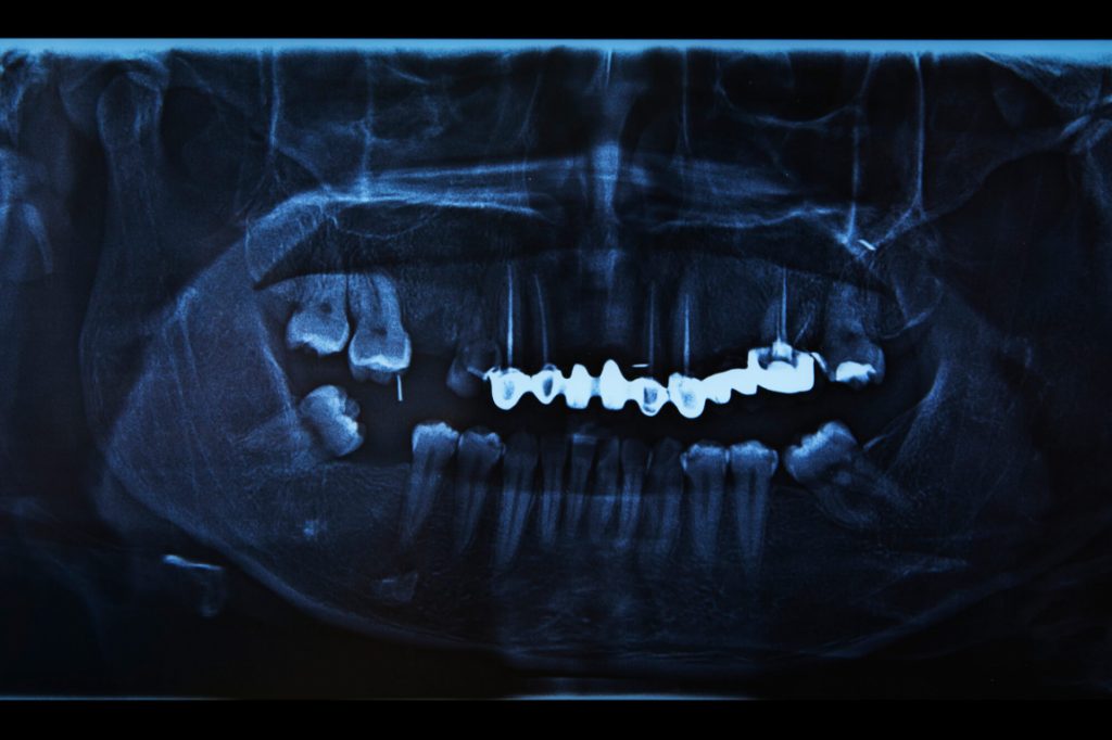 x-ray of crooked teeth by Medford orthodontist
