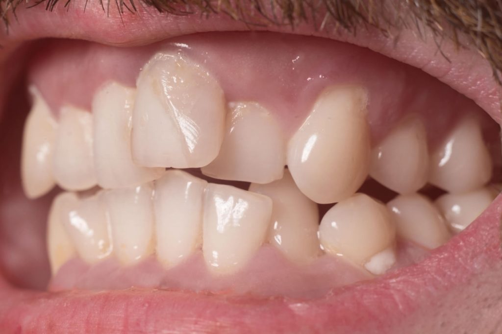 crooked teeth that needs to be addressed by a Medford orthodontist