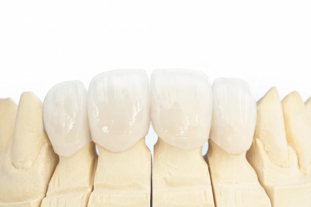 Illustration of dental Crowns in woodruff wi