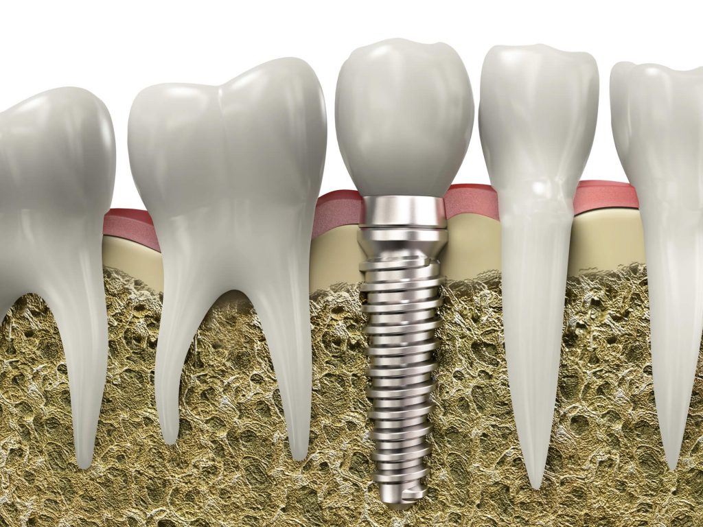 a dental implant without Bridges in woodruff wi