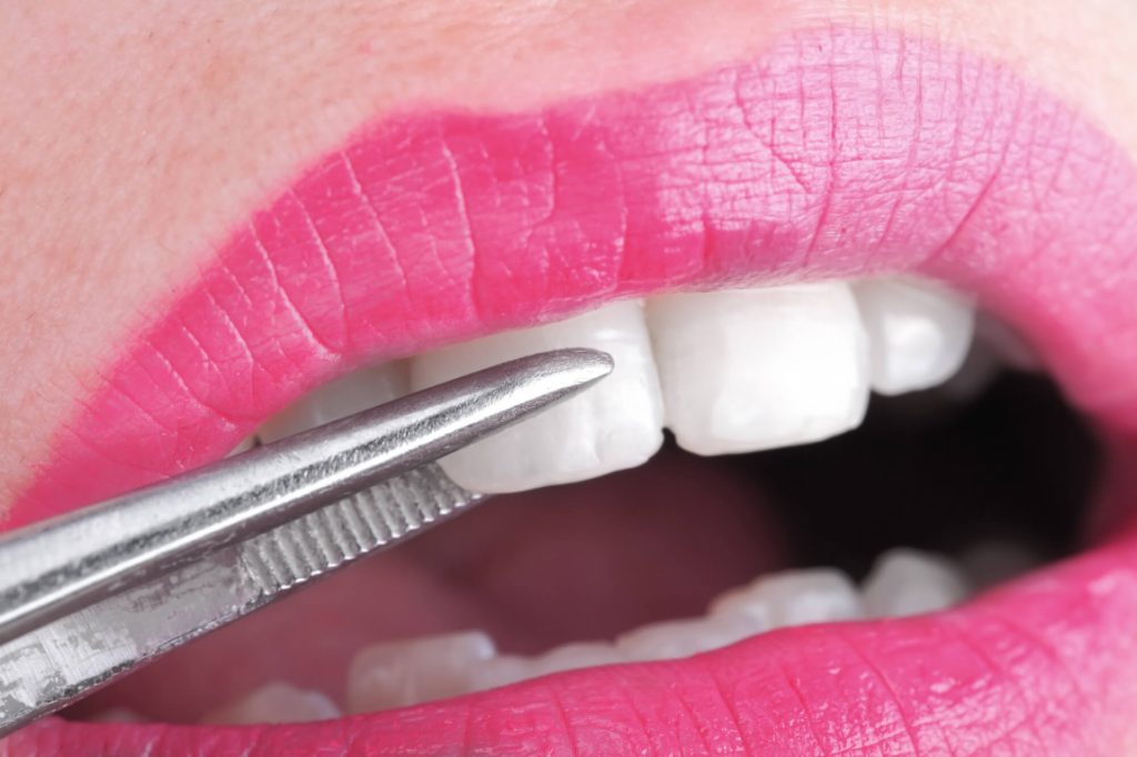 Illustration of veneers in phillips