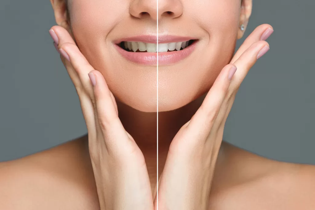 Before and after teeth whitening in Medford