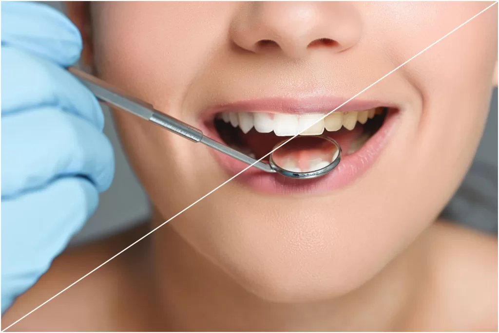Close up of a smile Before and after brite smile in phillips